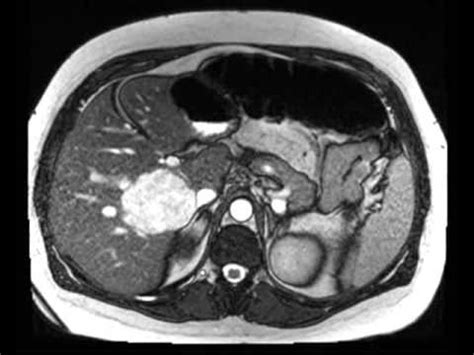 Liver Hemangioma Mri Enhancement