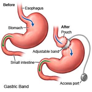 Adjustable Gastric Band Surgery - What You Need to Know