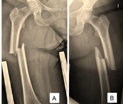 Fichas De Aprendizaje T25 Fisioterapia En Fracturas De FÉmur Y Partes