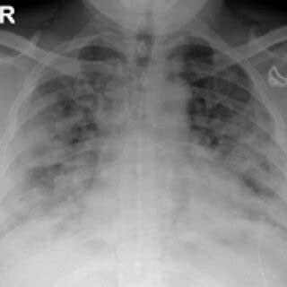 Chest Xray Pa View On Admission Shows Bilateral Multiple Peripheral