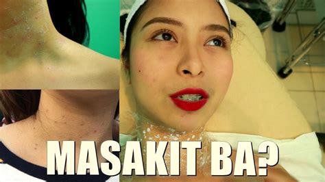 SOLUSYON SA KULUGO SA BALAT WARTS AT SKIN TAGS Step By Step