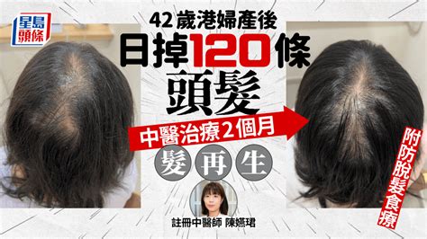 產後脫髮｜42歲港婦日掉120條頭髮 治療2個月髮再生 中醫拆解成因推介防脫髮食療