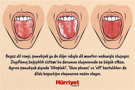 Dildeki renk değişimleri hangi hastalıkların habercisi Sağlıklı dil