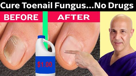 How To Cure Toenail Fungus For Pennies A Day Dr Mandell Youtube