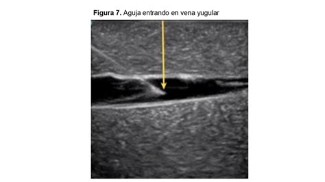 Implantaci N Ecoguiada De Cat Teres Tunelizados Para Hemodi Lisis