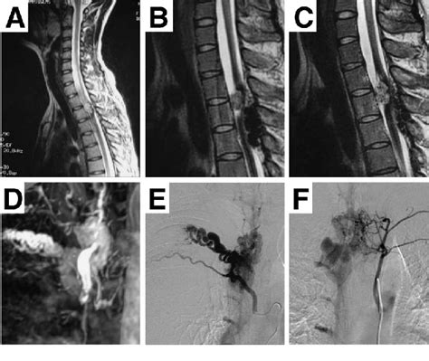 A C Sagittal T Weighted Magnetic Resonance Mr Images Showing A