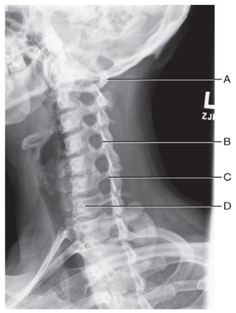 Cervical Spine Oblique Diagram Quizlet