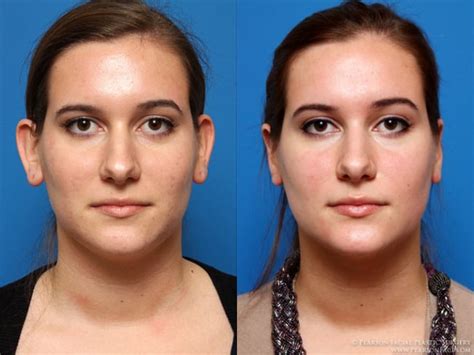 Otoplastia Antes E Depois Resultados Impressionantes