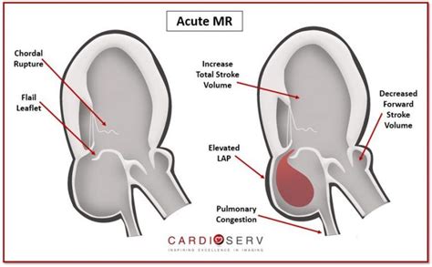 Aortic Stenosis Breaking Down The Continuity Equation Artofit