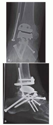 Aseptic Loosening Musculoskeletal Key