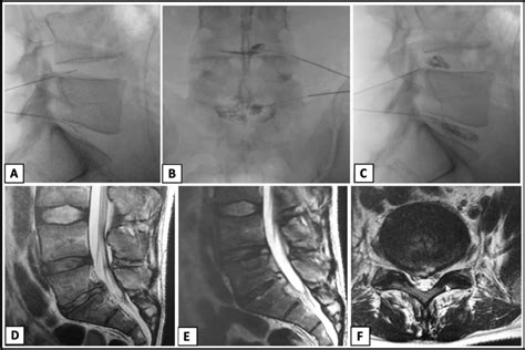 Case 3 A Lateral Fluoroscopic Image Demonstrating L4 L5 And L5 S1