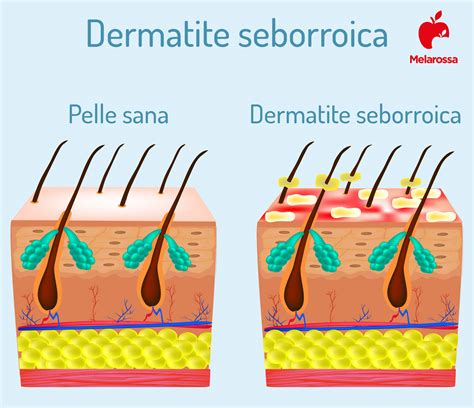 Dermatite Seborroica Cause E Sintomi Saperesalute It Hot Sex Picture