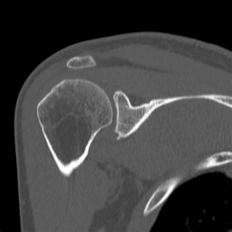 Bankart Lesion Image Radiopaedia Org