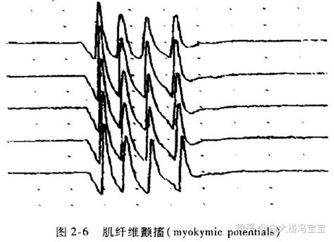 常规肌电图解读怎么入门？ 知乎