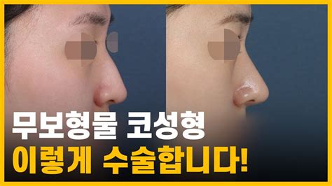 보형물 없이 자가연골 코끝 수술로만 예뻐지는 방법 히트성형외과 코성형 무보형물 코성형 장단점 Youtube