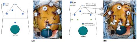 Laparoscopic Donor And Recipient Hepatectomy Followed By Robot Assisted