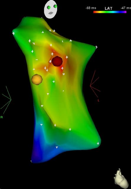 The Activation Map Of The AF Triggering APB On The CARTO System This