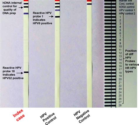 Inno Lipa Hpv Pcr Genotyping Assay Illustrating Hpv Positivity On Lipa