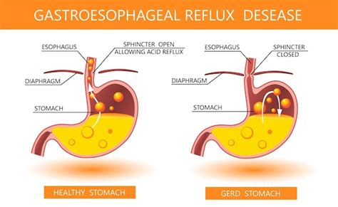 Doença do refluxo gastroesofágico 3d infográfico de refluxo ácido