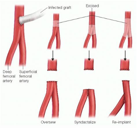 Management Of The Infected Femoral Graft Basicmedical Key