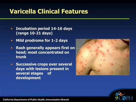 Ppt Varicella Chickenpox And Herpes Zoster Shingles Powerpoint