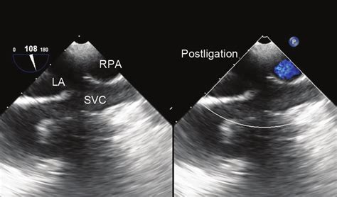 Transesophageal Echocardiographic Image Midesophageal Bicaval View Download Scientific Diagram