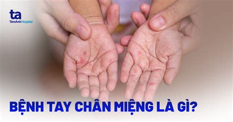 Bệnh Tay Chân Miệng Dấu Hiệu Nhận Biết And Chăm Sóc Trẻ đúng Cách