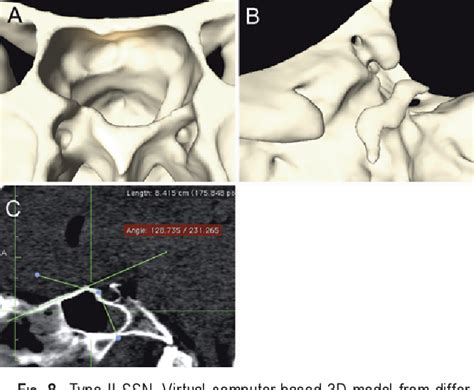 Figure From The Suprasellar Notch Or The Tuberculum Sellae As Seen