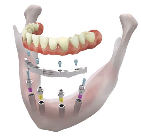 All On Four Six Dental Implants Istanbul Turkey Costs Reviews