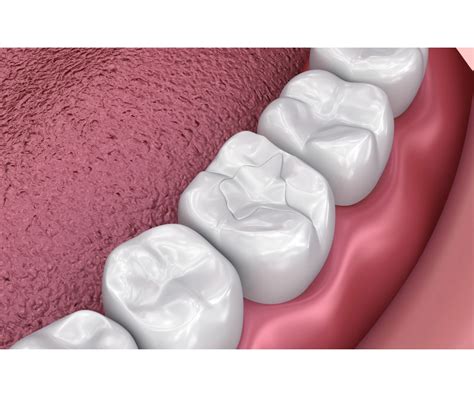 Pasta Teeth: Dental Filling Guide for the Philippines in 2024 by Dr Jeff