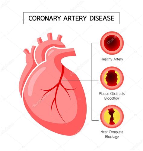 Corazón humano con enfermedad arterial coronaria info graphic Arteria