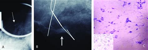 A 45-year-old woman with left mastectomy. A, B. Spot compression ...