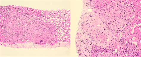 Hepatic Sarcoidosis Presenting As Hypercalcemia The American Journal