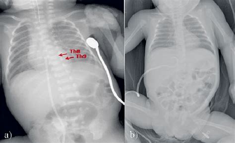 Low Lying Umbilical Vein Catheter