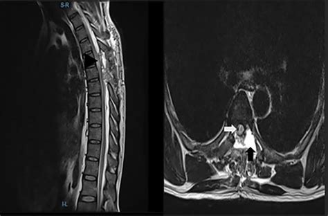 Thoracic Spinal Intradural Arachnoid Cyst With A Fulminant Course