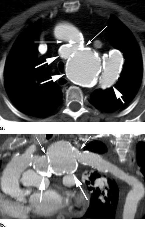 Aortic Pseudocoarctation Contrast Enhanced Axial Ct Scan A And