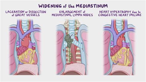 video anatomy clinical correlates mediastinum