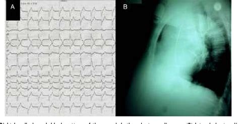 Figure From Endocardial Left Ventricular Pacing After Accidental