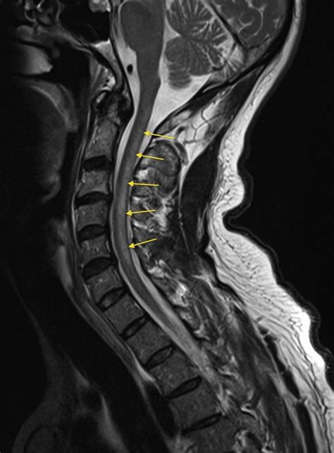 Subacute Combined Degeneration Of The Cord Radiology At St Vincent S University Hospital