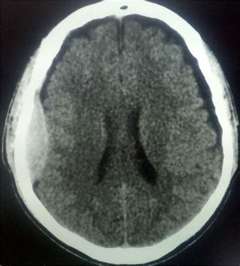 Evaluation Of Common Findings In Brain Computerized Tomography Ct