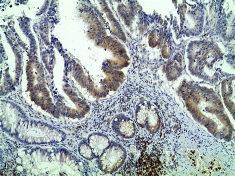 Immunohistochemical Staining For Bcl 2 In Colorectal Cancer Tissue