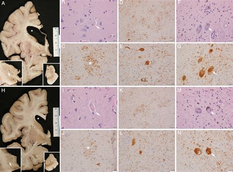 Pathology‐proven Corticobasal Degeneration Presenting As Richardson S Syndrome Bayram 2020