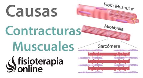 Contracturas musculares Cómo suceden y cuáles son sus causas