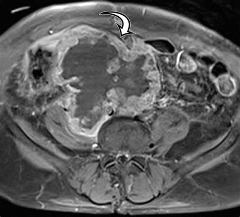 Soft Tissue Sarcomas Of The Abdomen And Pelvis Radiologic Pathologic