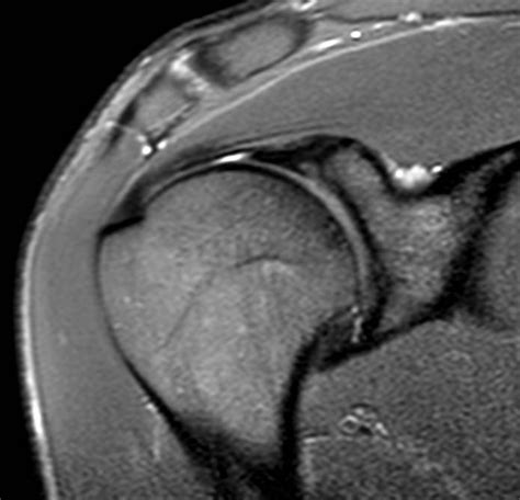 Torn Labrum | How bad is it? : r/MRI