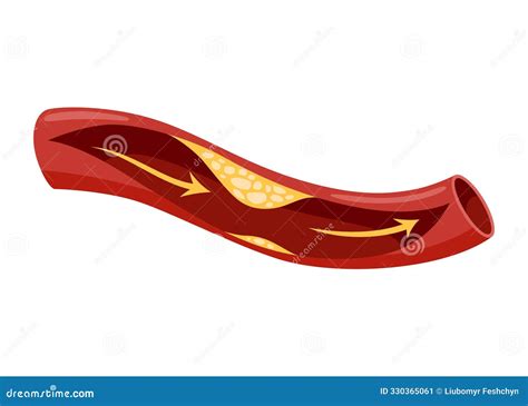 Atherosclerosis Stage Anatomy Of Heart Attack Arteriosclerotic