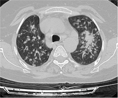 Axial Thoracic Ct Scan With Lung Parenchyma Window Of A 58 Year Old