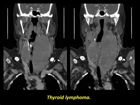 Presentation1 Pptx Radiological Imaging Of The Thyroid Gland Disease