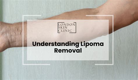 Understanding Lipoma Removal London Skin Clinic