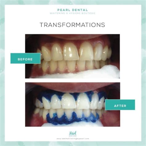 Gallery - Teeth Whitening Vancouver - Laser Teeth Whitening | Pearl ...